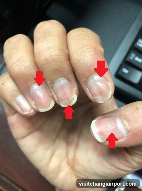 Hand with Nail Issues